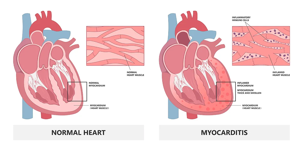 Image shows a healthy heart and a heart affected by myocarditis with inflammatory cells and heart muscle that is thick, swollen and inflamed.  