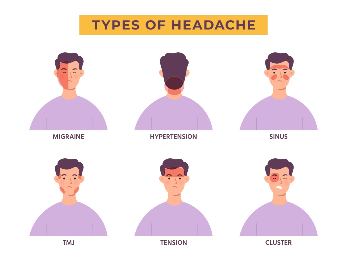 Image shows where to expect pain in six common types of headaches – migraine, hypertension, sinus, TMJ, tension and cluster. 