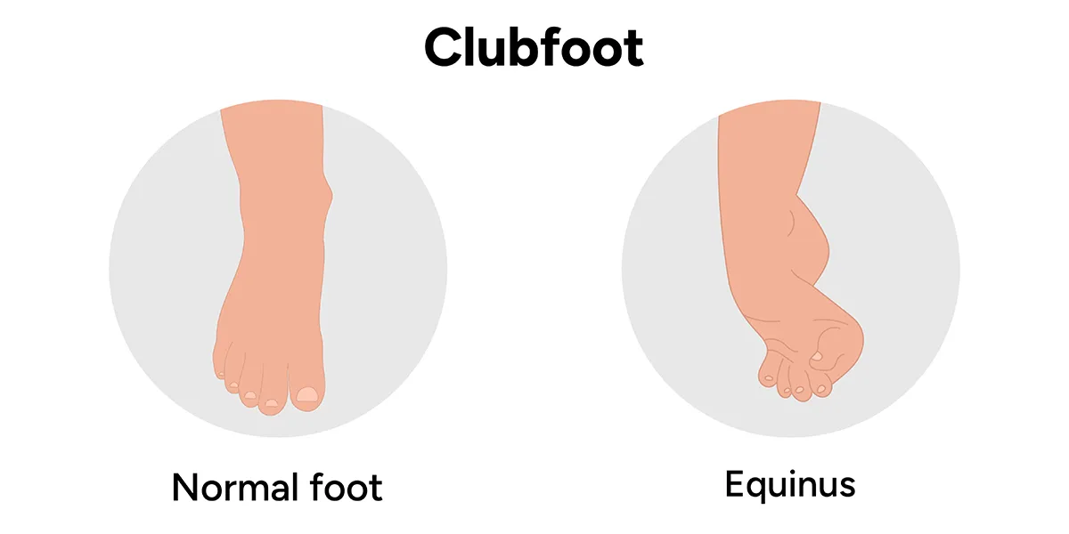 The illustration shows a normal foot on the left and a foot with clubfoot (equinus) on the right, where the foot twists inward, highlighting the deformity. 