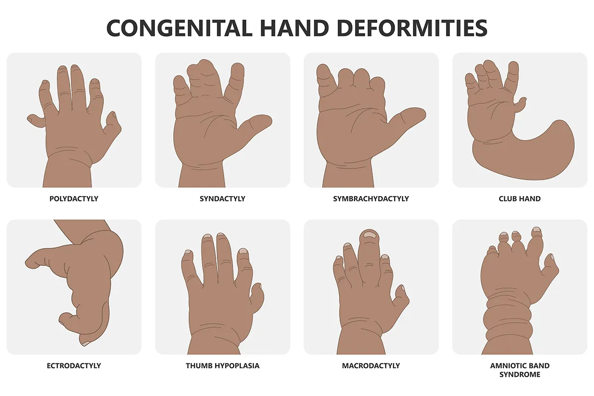 Illustrations showing different types of congenital hand deformities: Polydactyly (extra fingers), syndactyly (fused fingers), symbrachydactyly (short fingers), club hand (radial deviation), ectrodactyly (split hand), thumb hypoplasia (underdeveloped thumb), macrodactyly (abnormally large fingers) and amniotic band syndrome (constriction of limbs by amniotic bands). 