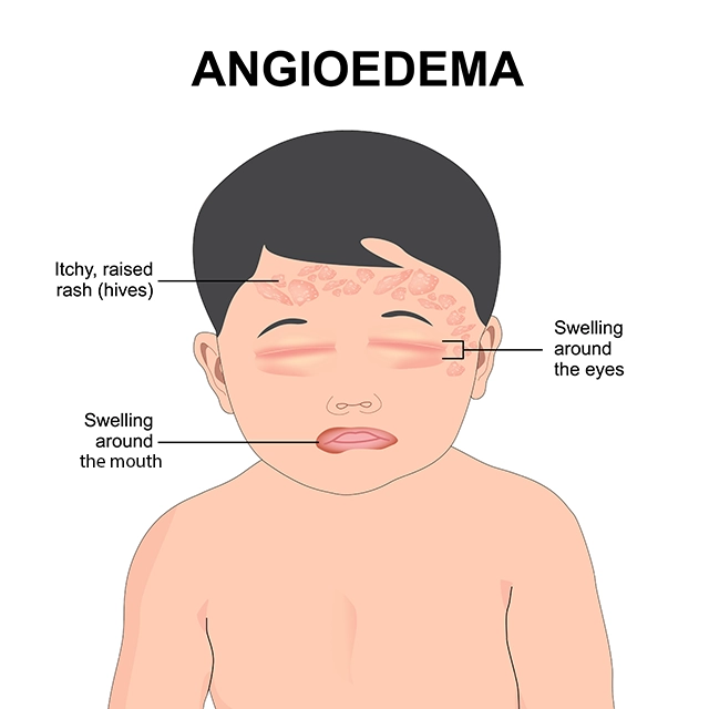 The illustration depicts a child with angioedema who has swelling around the eyes and lips and an itchy, raised rash (hives) on the forehead.